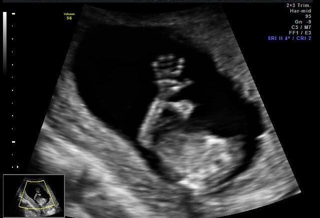 O segundo trimestre de gravidez O segundo trimestre de gravidez