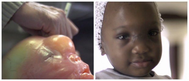 Deformação no crânio de menina é operada com ajuda de impressora 3D