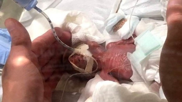 O menino com 5 dias de vida. Foto: Keio University Hospital